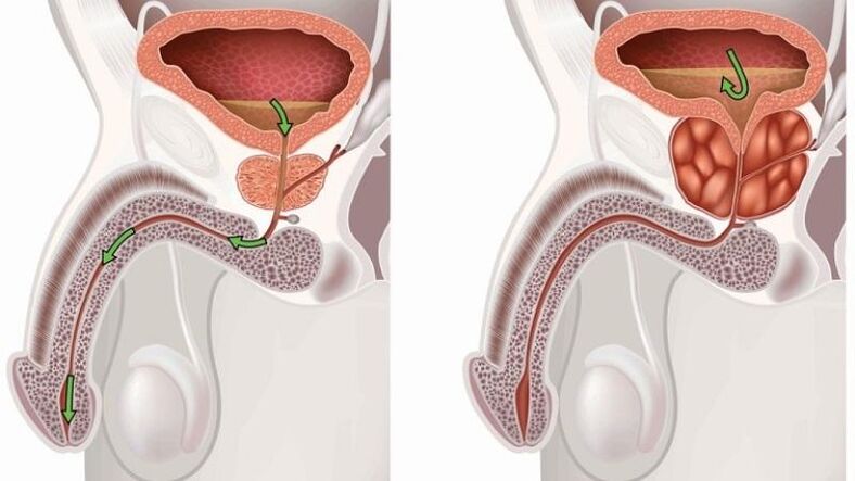 stagnatie van urine over prostatitis