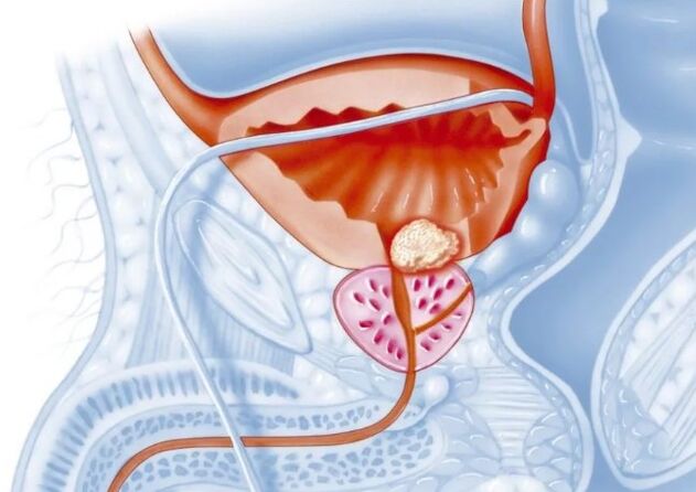 Kenmerken van chronische prostatitis